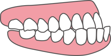 下顎前突(かがくぜんとつ)