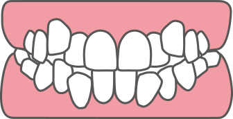 上顎前突(じょうがくぜんとつ)