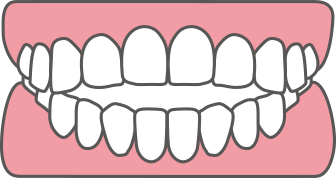 上顎前突(じょうがくぜんとつ)