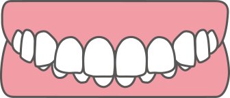 上顎前突(じょうがくぜんとつ)